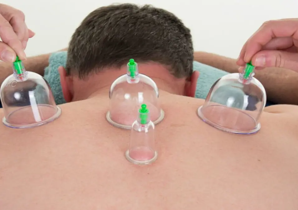 رجل يتلقى جلسة حجامة على ظهره، يوحي بفوائد الحجامة للصحة الجنسية ودورها في تحسين الانتصاب والرغبة.