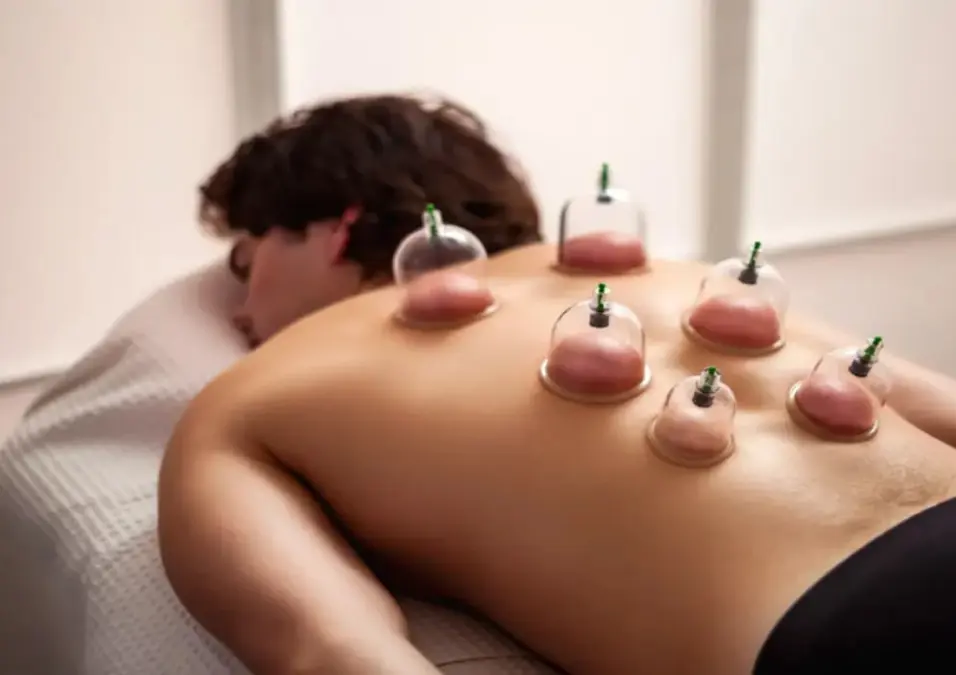 أكواب الحجامة على ظهر رجل، توحي بفوائد الحجامة للرجال وكل ما تحتاج معرفته قبل التجربة.