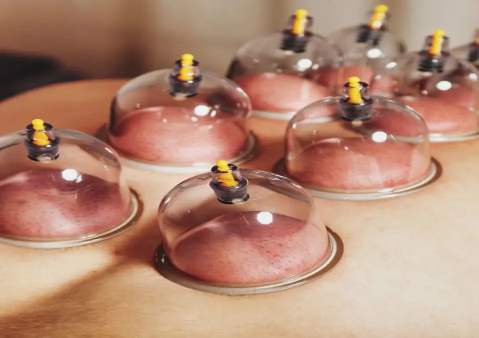  أكواب الحجامة على ظهر شخص، توحي بدليل كامل لفوائد الحجامة ومخاطرها مع أنسب أوقاتها.